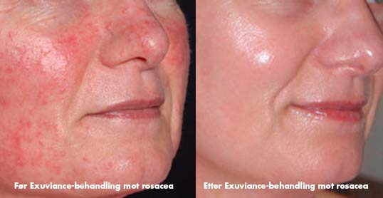 Rosacea