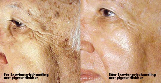 Før Exuviance-behandling for og mot pigmentflekker